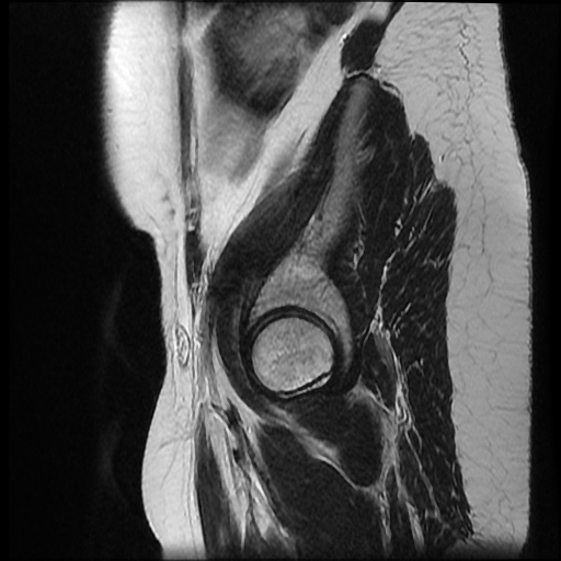 File:Bicornuate uterus (Radiopaedia 51676-57472 Sagittal T2 1).jpg