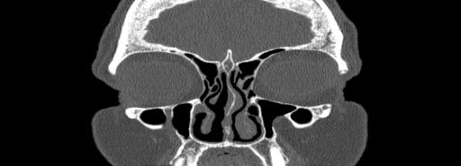 File:Bilateral Ectopic Infraorbital Nerves (Radiopaedia 49006-54084 Coronal bone window 14).jpg