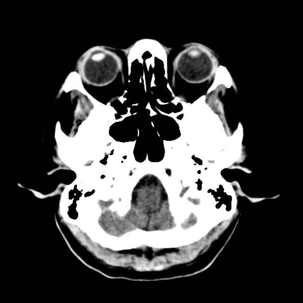 File:Bilateral PCA territory infarction - different ages (Radiopaedia 46200-50591 Axial non-contrast 2).jpg