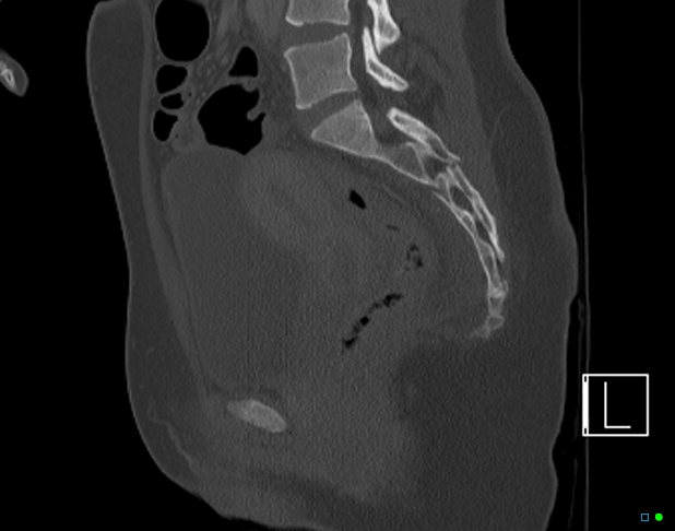 Bilateral acetabular fractures (Radiopaedia 79272-92308 Sagittal bone window 44).jpg