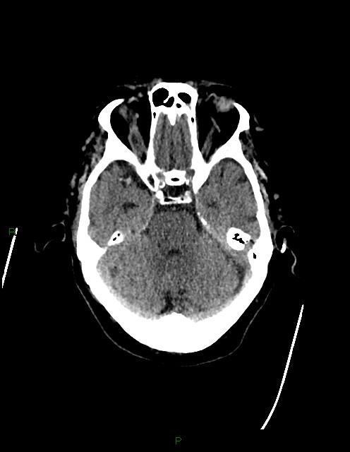 Bilateral acute middle cerebral artery territory infarcts (Radiopaedia 77319-89401 Axial non-contrast 27).jpg