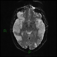 File:Bilateral acute middle cerebral artery territory infarcts (Radiopaedia 77319-89402 Axial DWI 11).jpg