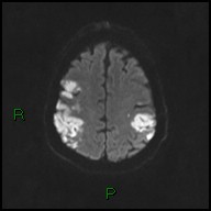 File:Bilateral acute middle cerebral artery territory infarcts (Radiopaedia 77319-89402 Axial DWI 43).jpg
