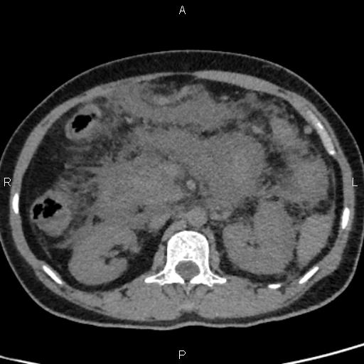 Bilateral adrenal gland hyperenhancement in pancreatitis (Radiopaedia 86642-102753 Axial non-contrast 47).jpg