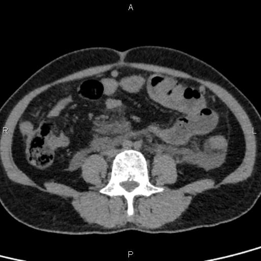 Bilateral adrenal gland hyperenhancement in pancreatitis (Radiopaedia 86642-102753 Axial non-contrast 70).jpg