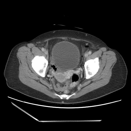 Bilateral adrenal granulocytic sarcomas (chloromas) (Radiopaedia 78375-91007 A 105).jpg