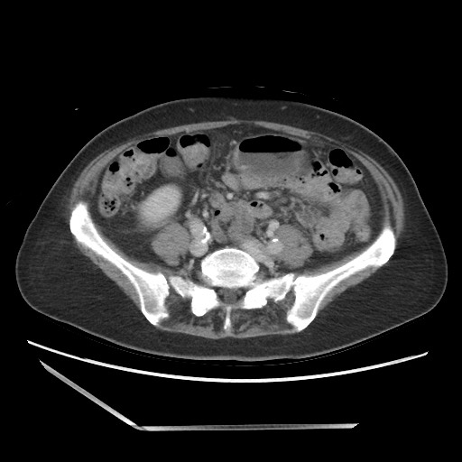 Bilateral adrenal granulocytic sarcomas (chloromas) (Radiopaedia 78375-91007 A 77).jpg
