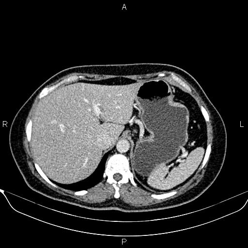 Bilateral benign adrenal adenomas (Radiopaedia 86912-103124 B 25).jpg