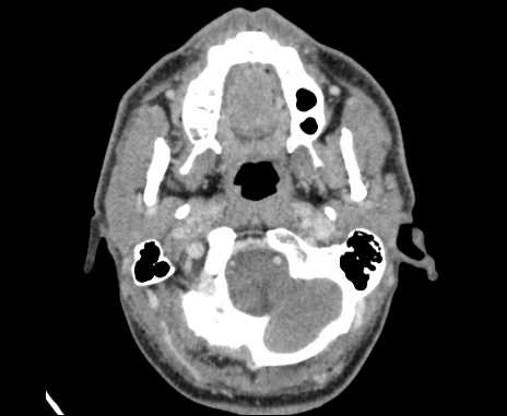 Bilateral carotid body tumors (Radiopaedia 61841-69870 Axial Post contrast 15).jpg