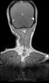 File:Bilateral carotid body tumors and right glomus jugulare tumor (Radiopaedia 20024-20060 MRA 71).jpg