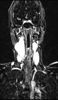File:Bilateral carotid body tumors and right glomus jugulare tumor (Radiopaedia 20024-20060 MRA 97).jpg
