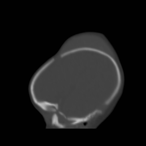 File:Bilateral cephalohematomas and subdural hematomas (Radiopaedia 26778-26929 Sagittal bone window 7).jpg