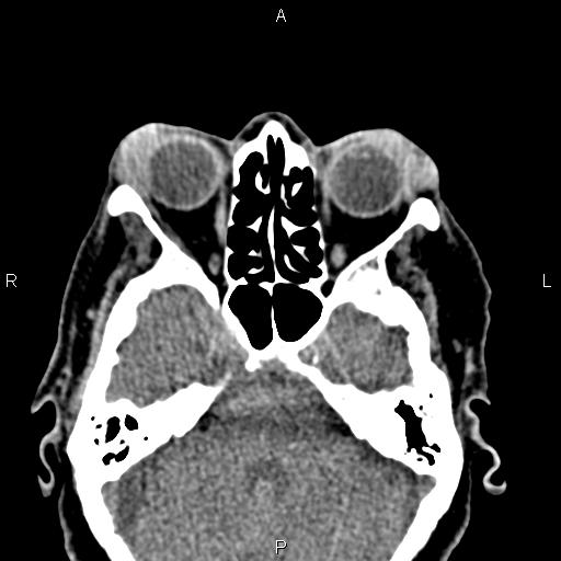 Bilateral enlargement of lacrimal glands - sarcoidosis (Radiopaedia 62627-70921 Axial non-contrast 40).jpg