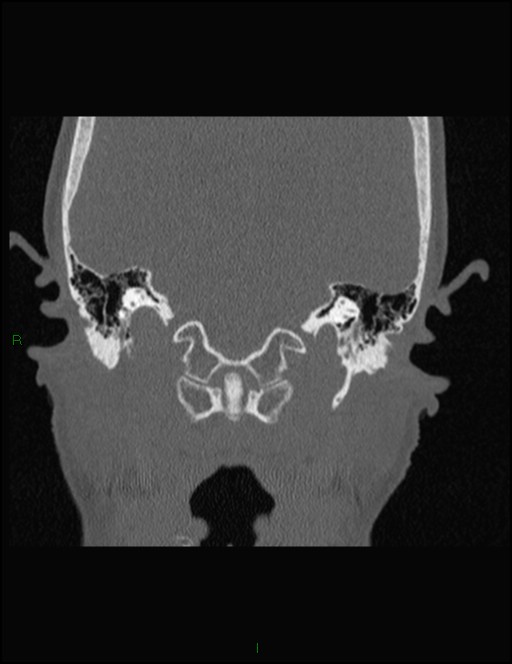 Bilateral frontal mucoceles (Radiopaedia 82352-96454 Coronal 321).jpg
