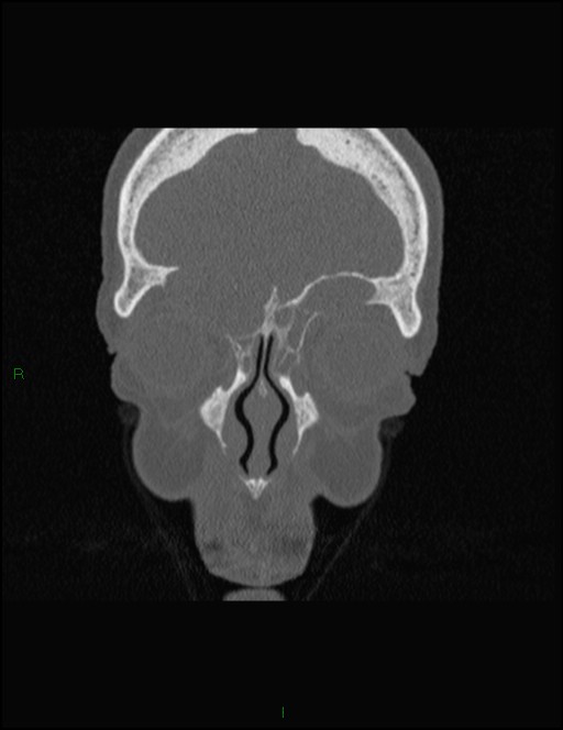 Bilateral frontal mucoceles (Radiopaedia 82352-96454 Coronal 84).jpg