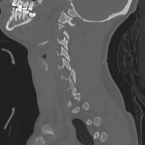 Bilateral locked facets (Radiopaedia 33850-35016 Sagittal bone window 8).png
