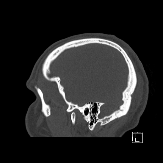 Bilateral occipital condyle fracture (type 2) (Radiopaedia 87675-104089 Sagittal bone window 5).jpg