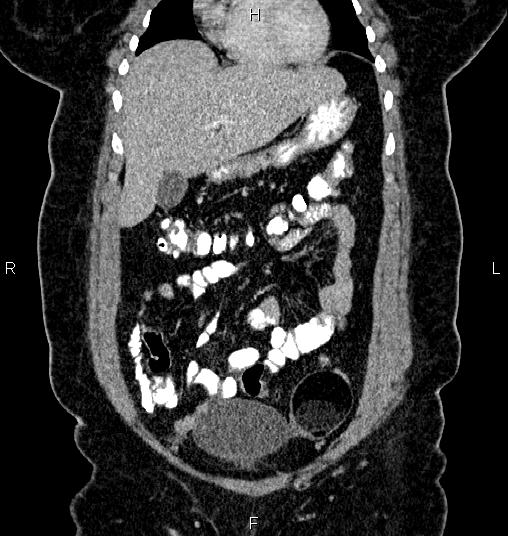 Bilateral ovarian dermoid cysts (Radiopaedia 85785-101603 C 11).jpg