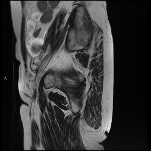 File:Bilateral ovarian fibroma (Radiopaedia 44568-48293 Sagittal T2 5).jpg