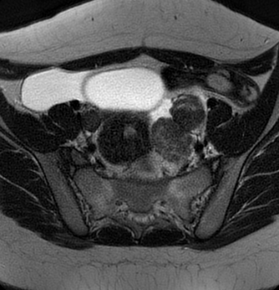 File:Bilateral ovarian fibrothecomas - adolescent (Radiopaedia 86604-102707 Axial T2 14).jpg