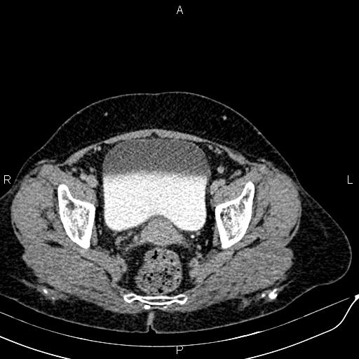 Bilateral ovarian serous cystadenocarcinoma (Radiopaedia 86062-101989 Axial C+ delayed 71).jpg
