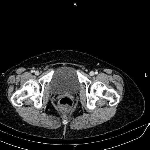 Bilateral ovarian serous cystadenocarcinoma (Radiopaedia 86062-101989 B 100).jpg