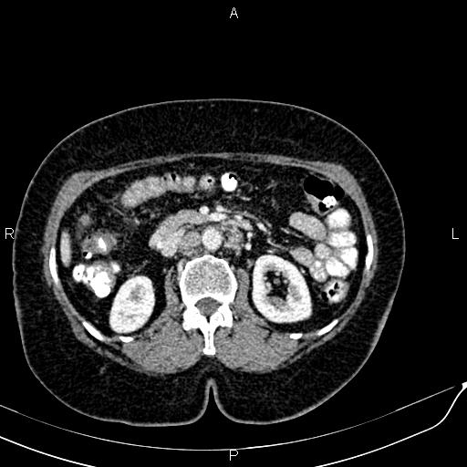 Bilateral ovarian serous cystadenocarcinoma (Radiopaedia 86062-101989 B 43).jpg