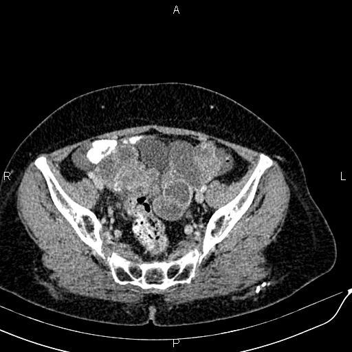 Bilateral ovarian serous cystadenocarcinoma (Radiopaedia 86062-101989 B 84).jpg