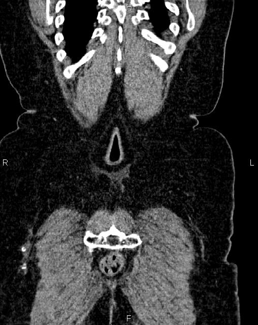 Bilateral ovarian serous cystadenocarcinoma (Radiopaedia 86062-101989 D 53).jpg