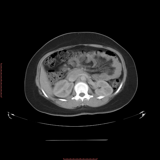File:Bilateral ovarian serous cystadenocarcinoma with right ovarian torsion (Radiopaedia 32640-33611 A 16).jpg