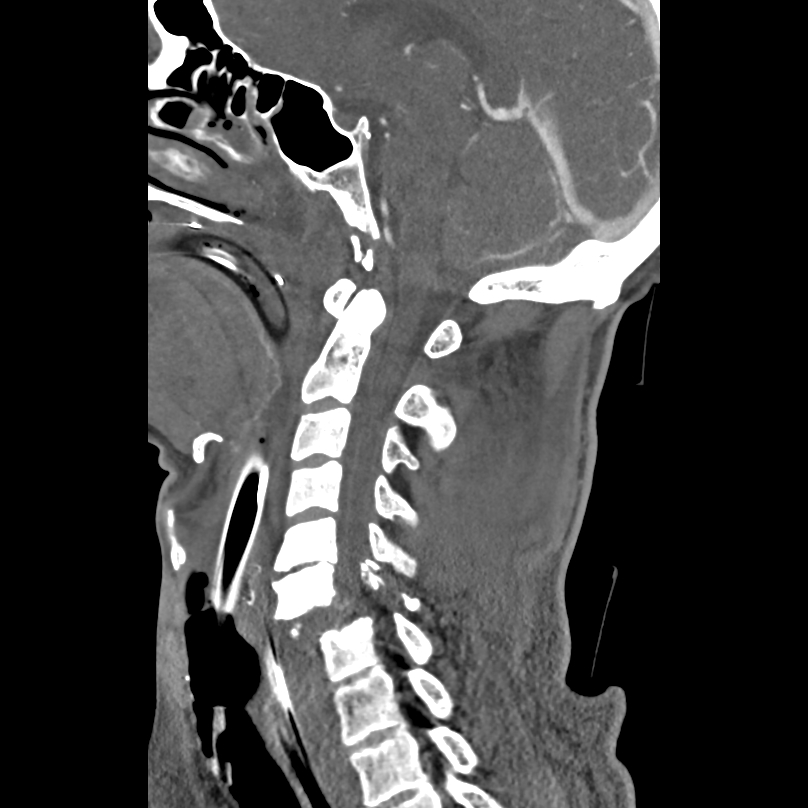 Bilateral perched facets with cord injury (Radiopaedia 45587-49713 B 24).jpg