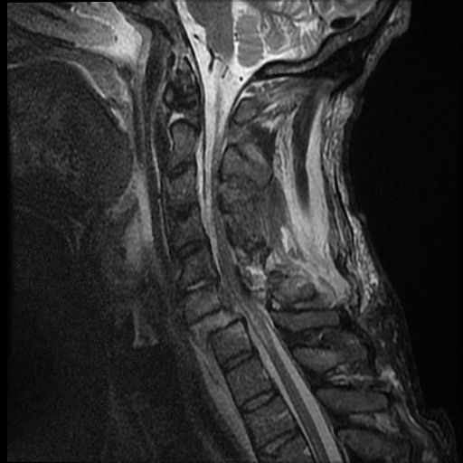 File:Bilateral perched facets with cord injury (Radiopaedia 45587-49714 Sagittal STIR 6).jpg