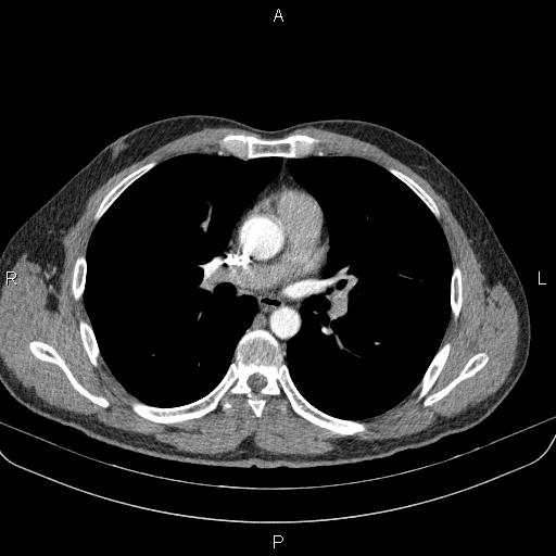 Bilateral pulmonary AVM (Radiopaedia 83134-97505 A 35).jpg