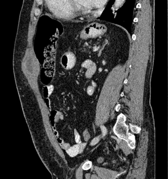 File:Bilateral rectus sheath hematomas (Radiopaedia 50778-56252 B 51).jpg