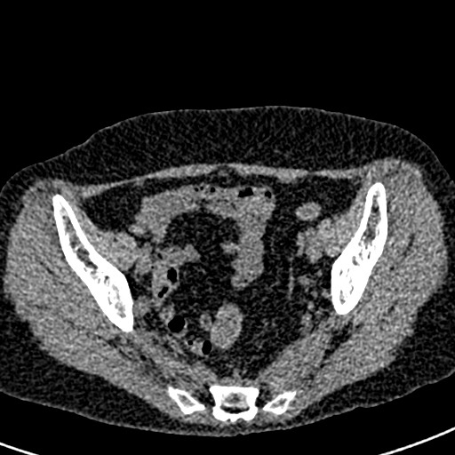 Bilateral staghorn calculi (Radiopaedia 59475-66842 Axial non-contrast 68).jpg