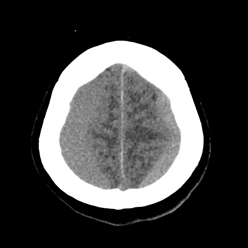 Bilateral subacute subdural hematoma (Radiopaedia 69240-79018 Axial non-contrast 43).jpg