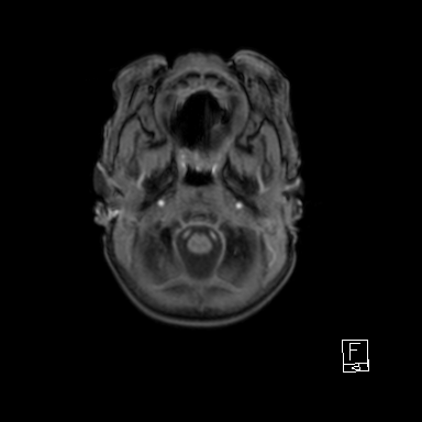 Bilateral subdural hemorrhage and parietal skull fracture (Radiopaedia 26058-26190 Axial T1 5).png