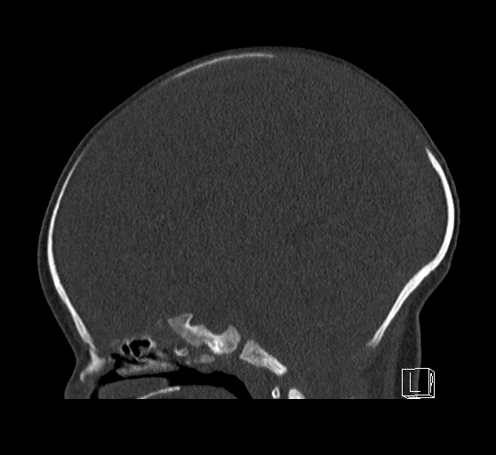 Bilateral subdural hemorrhage and parietal skull fracture (Radiopaedia 26058-26192 Sagittal bone window 45).png