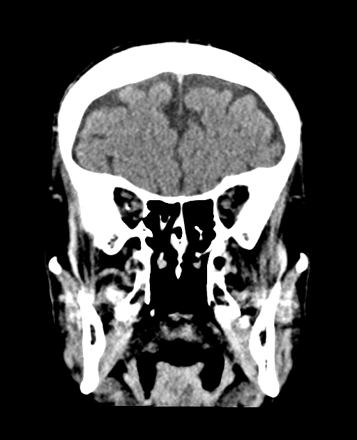 Bilateral subdural hygroma (Radiopaedia 73637-84421 Coronal non-contrast 12).jpg