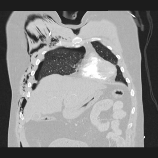 Bilateral traumatic renovascular injury (Radiopaedia 32051-32995 Coronal lung window 21).jpg