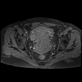 Bilateral tubo-ovarian abscesses (Radiopaedia 58635-65829 Axial T1 fat sat 27).jpg