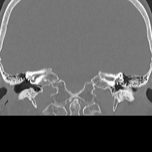 File:Bilateral tympanoplasty (Radiopaedia 16947-16664 Coronal bone window 13).jpg
