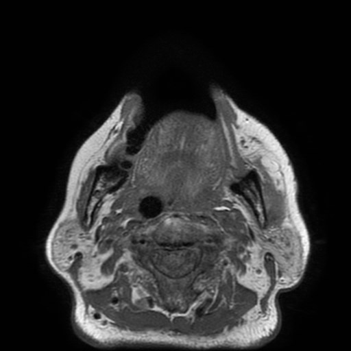 Bisphosphonate-related osteonecrosis of the maxilla (Radiopaedia 51367-57101 Axial T1 14).jpg