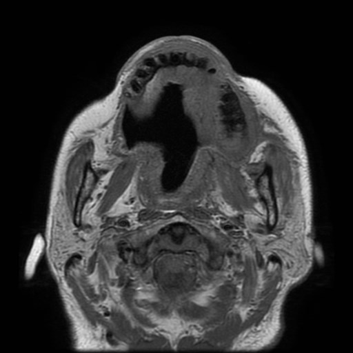 Bisphosphonate-related osteonecrosis of the maxilla (Radiopaedia 51367-57101 Axial T1 21).jpg