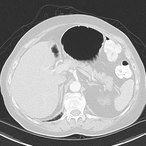 File:Bladder and bowel cancers (Radiopaedia 37688-39592 Axial lung window 52).png