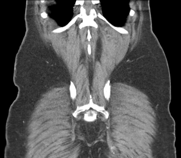 File:Bladder papillary urothelial carcinoma (Radiopaedia 48119-52951 C 56).png