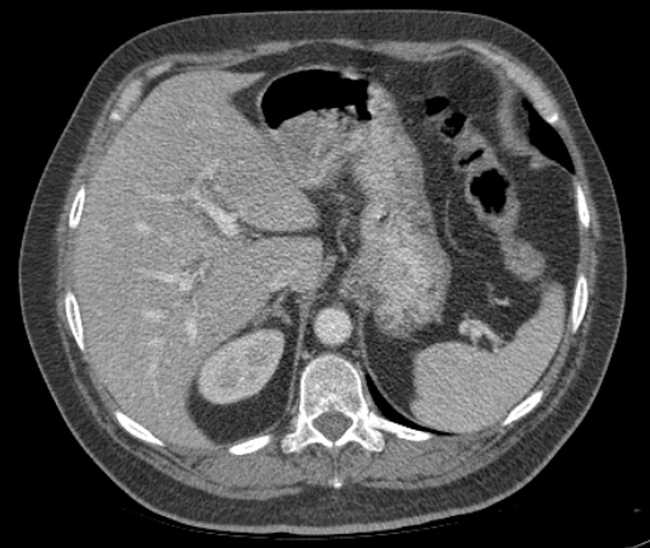 Bleeding duodenal ulcer and adenomyomatosis of gallbladder (Radiopaedia 61834-69861 A 25).jpg