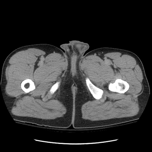 File:Blunt abdominal trauma with solid organ and musculoskelatal injury with active extravasation (Radiopaedia 68364-77895 Axial C+ delayed 154).jpg