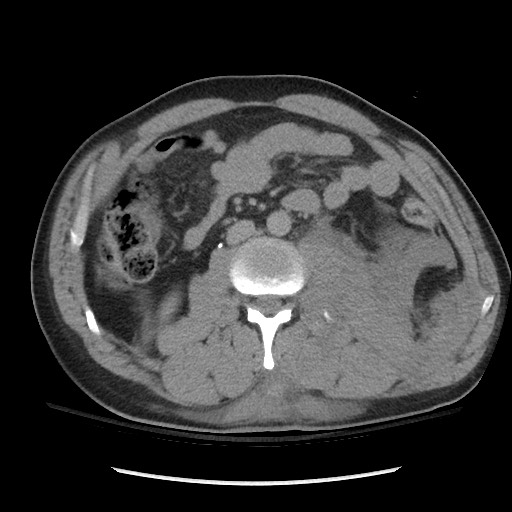 Blunt abdominal trauma with solid organ and musculoskelatal injury with active extravasation (Radiopaedia 68364-77895 Axial C+ delayed 70).jpg