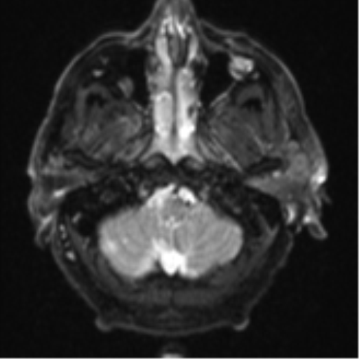 Blunt cerebrovascular injury (Radiopaedia 53682-59745 Axial DWI 5).png